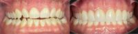 35-44 year old man treated with Smile Makeover