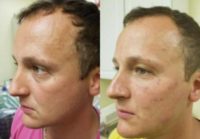 35-44 year old man treated with Laser Resurfacing