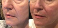 45-54 year old woman treated with Restylane Lyft
