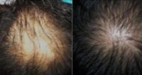 45-54 year old man treated with PRP for Hair Loss