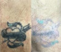 55-64 year old man treated with Tattoo Removal