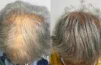 65-74 year old woman treated with PRP for Hair Loss