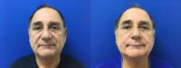 65-74 year old man treated with Sculptra Aesthetic