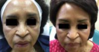 65-74 year old woman treated with Vampire Facelift
