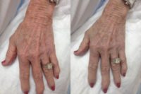 72 yo female with enlarged hand veins.