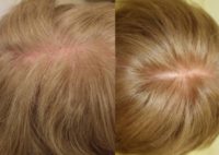 65-74 year old woman treated with PRP for Hair Loss