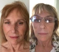 75 and up year old woman treated with Injectable Fillers