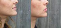 35-44 year old woman treated with Lip Augmentation - Volbella 1/2 ML