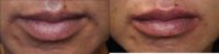 45-54 year old woman treated with Juvederm Ultra