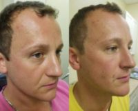35-44 year old man treated with Laser Resurfacing