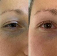 Woman treated with Lash Lift