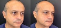 Man treated with Dermal Fillers