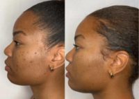 25-34 year old woman treated with Chemical Peel