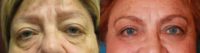 55-64 year old woman treated with Eye Bags Treatment