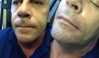 45-54 year old man treated with Restylane Defyne Nasal Labial Folds