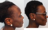 Woman treated with Hair Loss Treatment