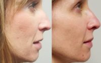Successful Acne Scar Treatment with Bellafill