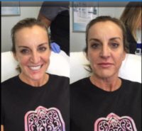 35-44 year old woman treated with Restylane Silk