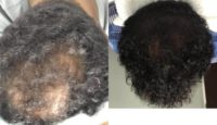 55-64 year old woman treated with PRP for Hair Loss