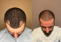 25-34 year old woman treated with ARTAS Robotic Hair Transplant