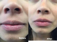 25-34 year old woman treated with HydraFacial-PERK for the Lips