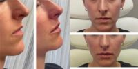 25-34 year old woman treated with Lip Fillers, Revanesse