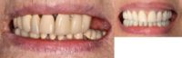 75 and up year old woman treated with Dental Implants