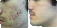 25-34 year old man treated with Spironolactone For Acne, Laser Resurfacing, CO2 Laser, YAG Laser, Fractional Laser, UltraPulse C