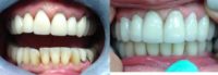 65-74 year old woman treated with Smile Makeover