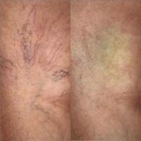 Woman treated with Yag Laser
