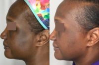 45-54 year old woman treated with Neo Laser