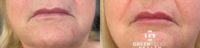 55-64 year old woman treated with Lip Fillers