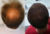 Man treated with Hair Transplant