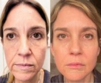 35-44 year old woman treated with Liquid Facelift, Dysport, Dermal Fillers, Botox