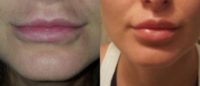18-24 year old woman treated with Restylane Refyne (Lip Augment)