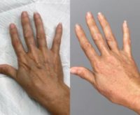 18-24 year old woman treated with Hand Rejuvenation