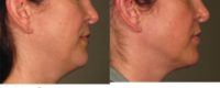 35-44 year old woman treated with Ultherapy (NECK treatment)