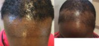 35-44 year old woman treated with PRP for Hair Loss