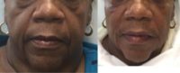65-74 year old woman treated with Voluma and Juvederm