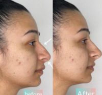 25-34 year old gender nonconforming person treated with Nonsurgical Nose Job