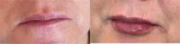 55-64 year old woman treated with Lip Fillers