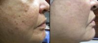 45-54 year old woman treated with Vampire Facial