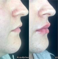 18-24 year old man treated with Injectable Fillers