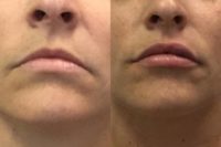 25-34 year old woman treated with Restylane Refyne