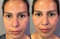 Woman treated with Dermal Fillers