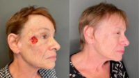 65-74 year old woman treated with Mohs Surgery