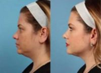 Woman treated with Kybella