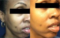 Woman treated with Microneedling