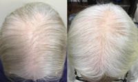 55-64 year old woman treated with Hair Loss Treatment