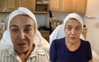 65-74 year old woman treated with Microneedling